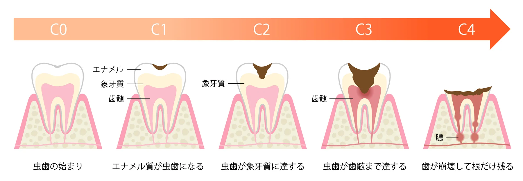 虫歯の進行段階と治療方法