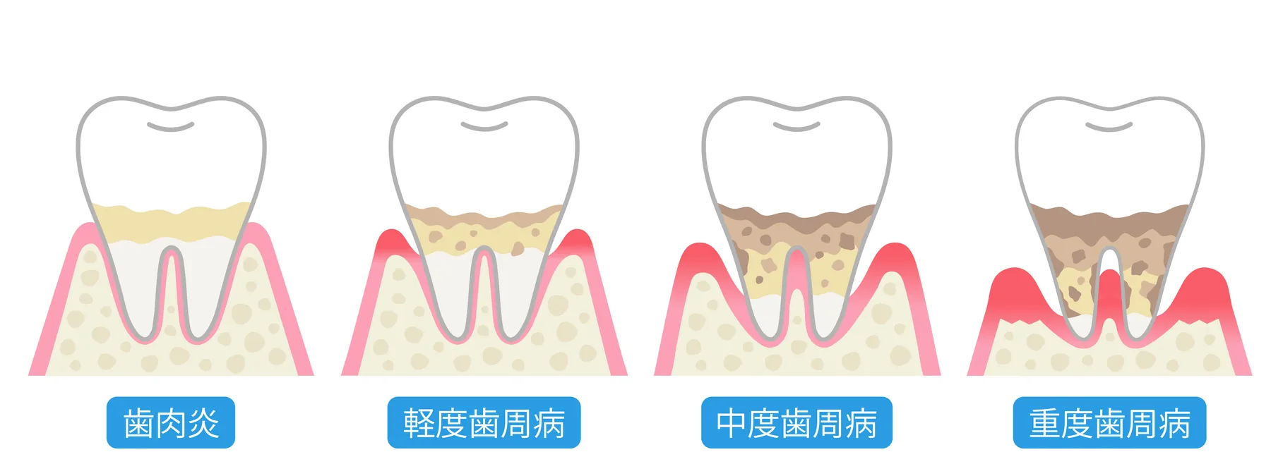 歯周病の進行段階と症状